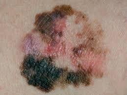 皮肤癌晚期图片,揭示癌变皮肤的严重变化